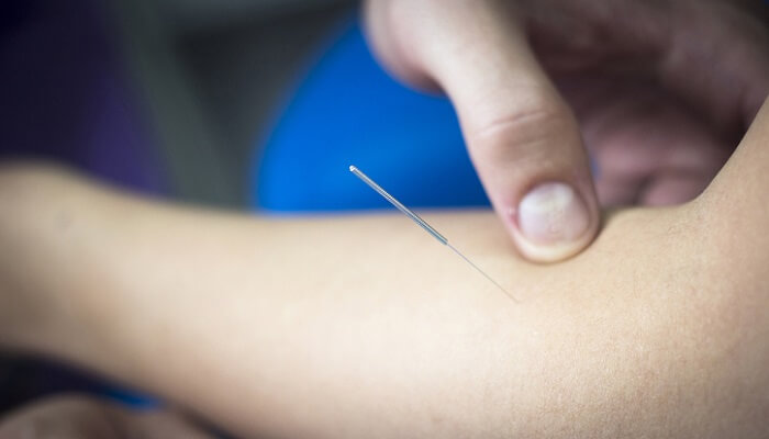 doctor putting acupuncture needle into forearm triple warmer meridian of patient
