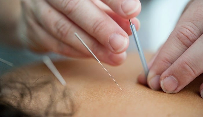 acupuncturist placing needles into patient's back
